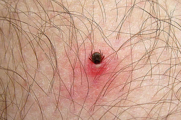 puntura zecca